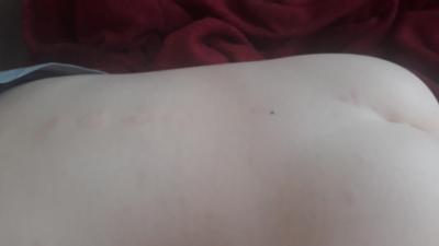 Alergie a ekzémy | Vyrážka u 8leté dcery poraďte