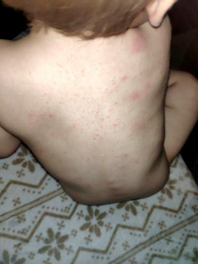 Alergie a ekzémy | Vyrážka / kopřivka/ potníčky u batolete