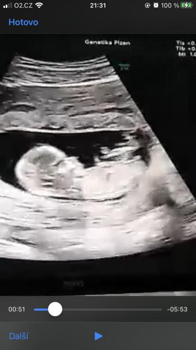 Těhotenství | Pohlaví podle ultrazvuku 12+4tt