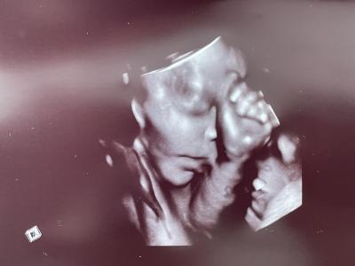Těhotenství | 3D ultrazvuk- podezření na rozštěp