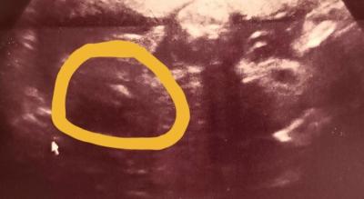Těhotenství | Vypadá to na holku nebo na kluka?