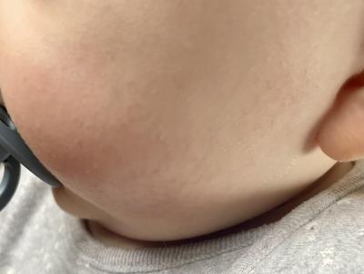 Alergie a ekzémy | Vyrážky na tváříčkách kojence