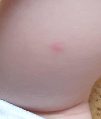 Batole (12 až 36 měsíců) | Pupínky po průjmu? 2 leté dítě