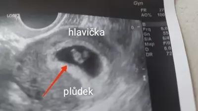 Těhotenství | Vysvětlení ultrazvuku