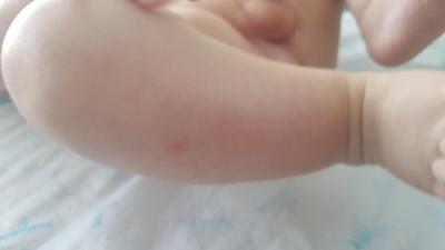 Alergie a ekzémy | Ekzém u 8 měsíčního