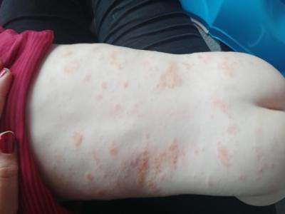 Batole (12 až 36 měsíců) | Ekzém co na něj , zkušenosti?