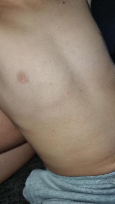Dětské nemoci | Vyrážka nebo neštovice?