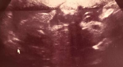 Těhotenství | Vypadá to na holku nebo na kluka?