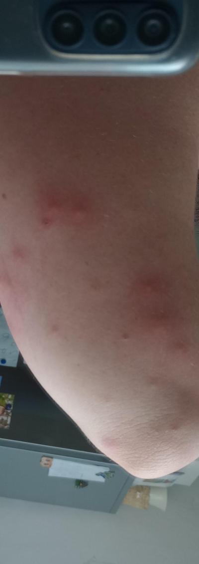 Alergie a ekzémy | Od čeho to můžou být Štípance?(foto)