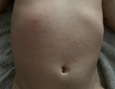 Dětské nemoci | Alergie na slunce dcera