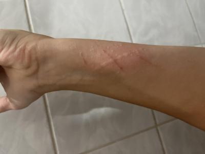 Alergie a ekzémy | Vyrážka alergie svrab