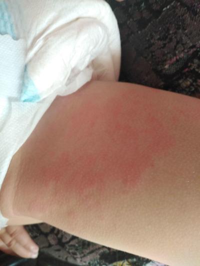 Dětské nemoci | Škaredá vyrážka u 3leté dcery