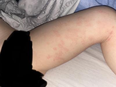 Předškoláček (3 až 6 let) | Svědivé mapy na stehnech