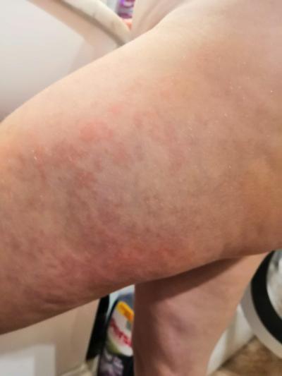 Alergie a ekzémy | Vyrážka na stehně u 4 letého