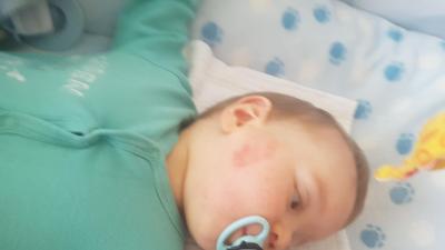 Alergie a ekzémy | Ekzém u 8 měsíčního