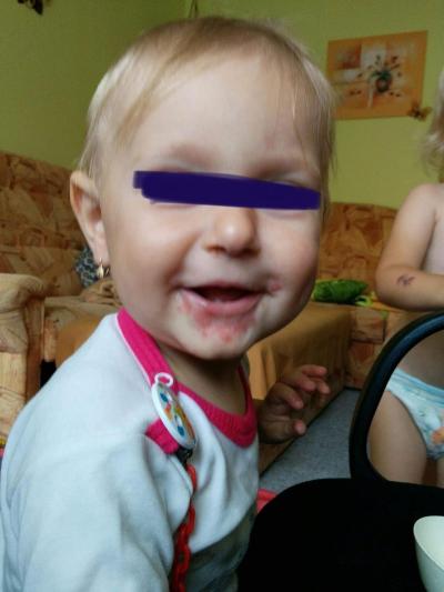 Dětské nemoci | Viróza s ekzémem