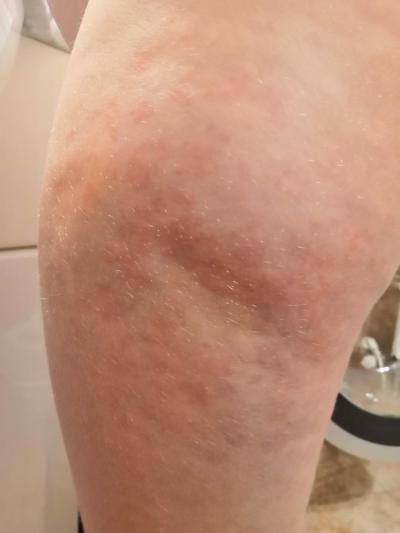 Alergie a ekzémy | Vyrážka na stehně u 4 letého
