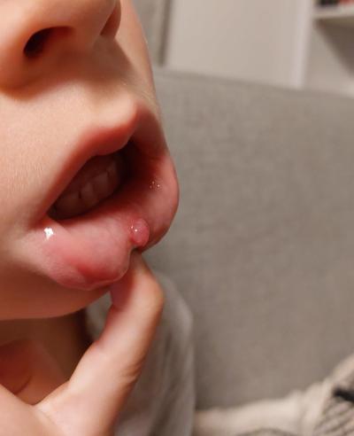Předškoláček (3 až 6 let) | Výrůstek v puse foto