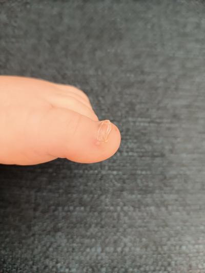 Batole (12 až 36 měsíců) | Puchýře na plosce u batolete