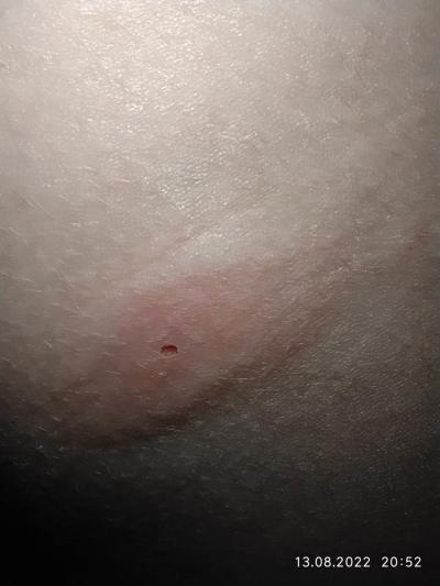 Alergie a ekzémy | Co je to za stipanec?