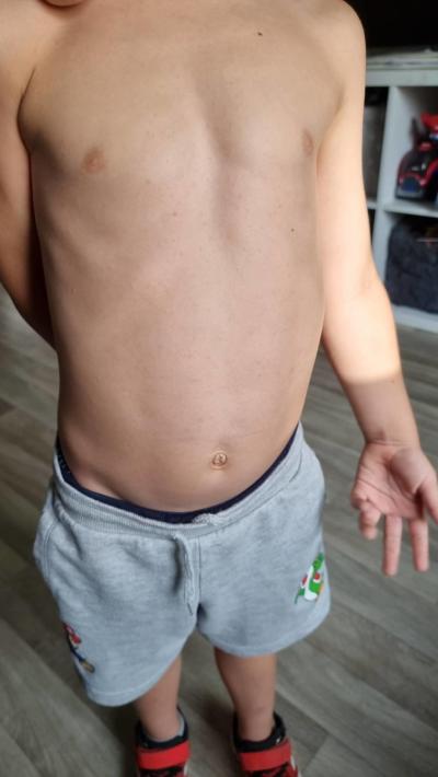 Dětské nemoci | Vyrážka nebo neštovice?