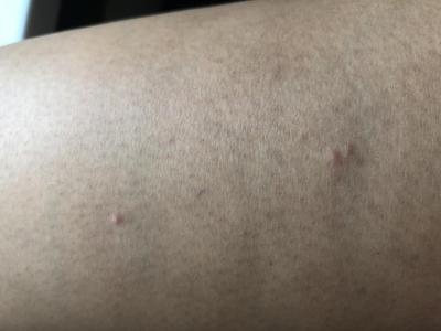 Alergie a ekzémy | Nesvědivé pupínky a flíčky