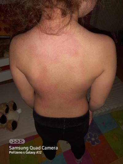 Alergie a ekzémy | Kopřivka? Co s tim delat