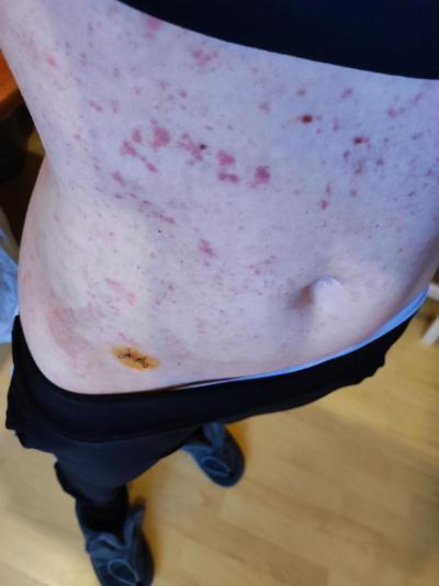 Zdravotní potíže dospělých | Vyrážka u dospělé osoby