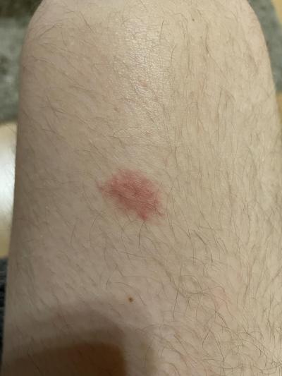 Alergie a ekzémy | Červený flek na stehně