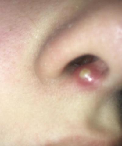Alergie a ekzémy | Boule v nose