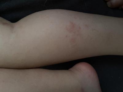 Dětské nemoci | Alergie na slunce dcera
