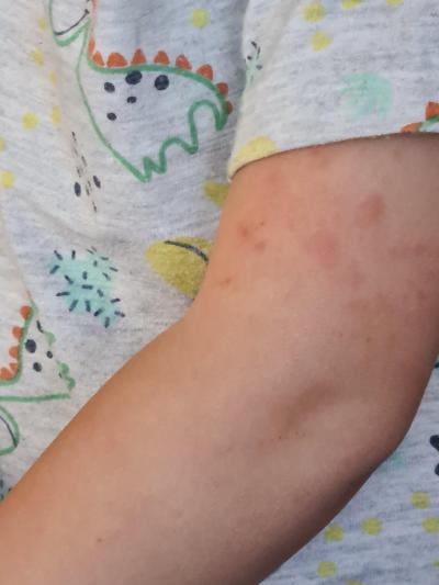 Alergie a ekzémy | Vyrážka dite 2 roky