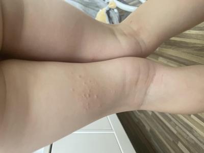 Alergie a ekzémy | Divné pupínky na nožičkách