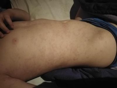Dětské nemoci | Vyrážka u 8lete dcery poraďte