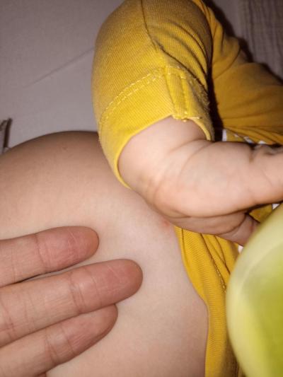 Dětské nemoci | Vyrážka nebo neštovice?