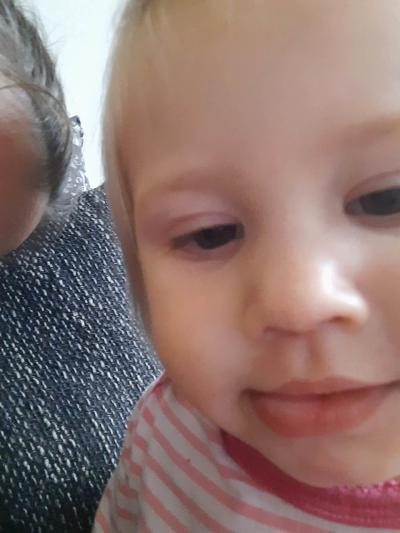 Dětské nemoci | Natekly ret jako puchýř