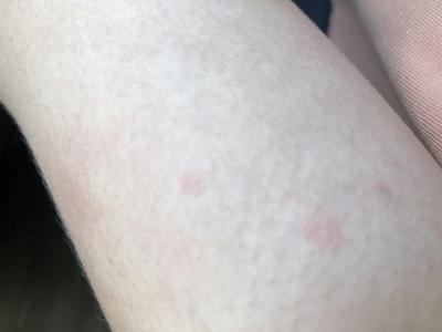 Alergie a ekzémy | Nesvědivé pupínky a flíčky