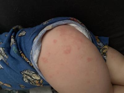 Dětské nemoci | Alergie na slunce dcera