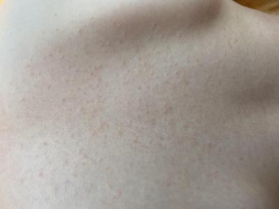 Dětské nemoci | Hrubá vyrážka na zádech