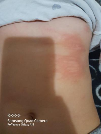 Alergie a ekzémy | Kopřivka? Co s tim delat