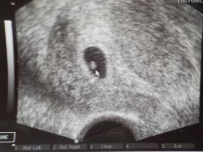 Těhotenství | Co vidíte na ultrazvuku 6+2tt ?