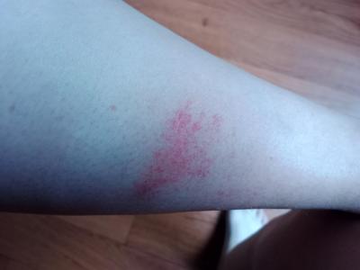 Alergie a ekzémy | Bodnutí včelou asi alergická reakce?