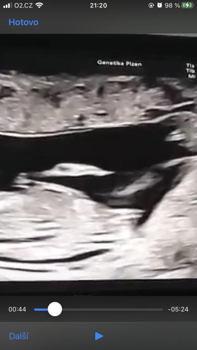 Těhotenství | Pohlaví podle ultrazvuku 12+4tt