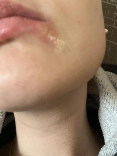 Zdravotní potíže dospělých | Virážka kolem pusy