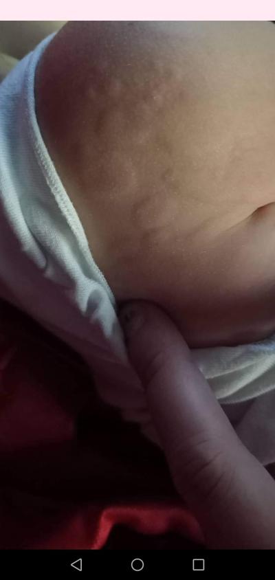 Dětské nemoci | Škaredá vyrážka u 3leté dcery