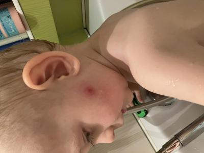 Alergie a ekzémy | Co je to za stipanec?