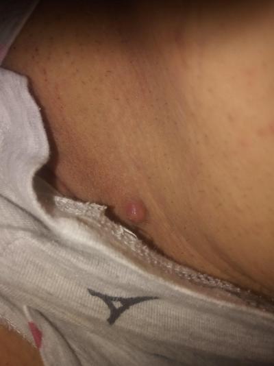 Gynekologické potíže | Boulička- bradavice v Třísle??