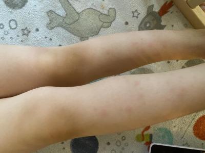Dětské nemoci | Viroza s vyrážkami