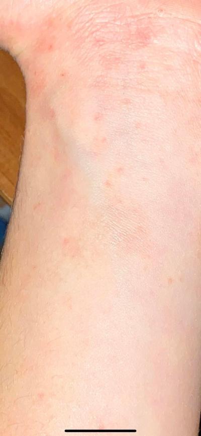Alergie a ekzémy | Ekzem na těle