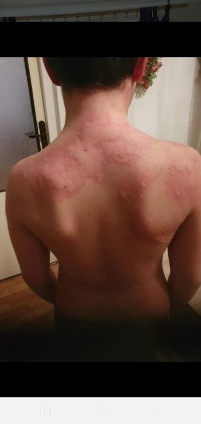 Alergie a ekzémy | Alergie a testy